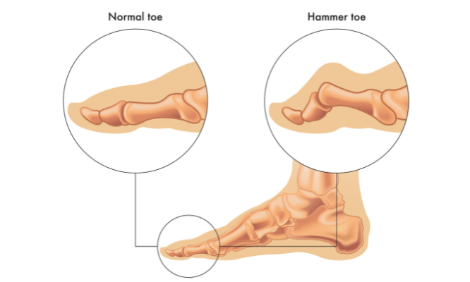 Treatment Options for Hammertoes – What to do when you have hammertoes