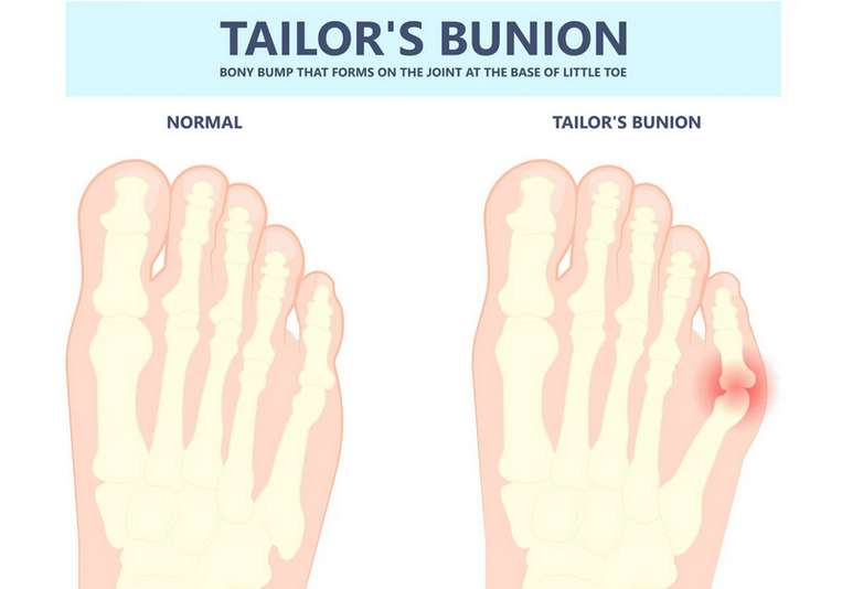 What Causes a Tailor's Bunion: Understanding the Root of the Problem