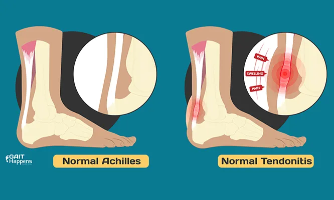 Know the Symptoms of Achilles Tendonitis Tendinopathy Gait Happens